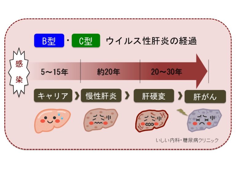 慢性のウイルス性肝炎の経過は？ | いしい内科・糖尿病クリニック｜肝臓専門医