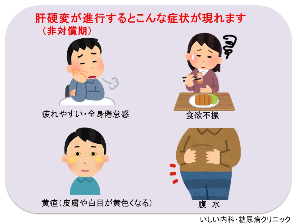 代償性肝硬変または非代償性肝硬変の診断